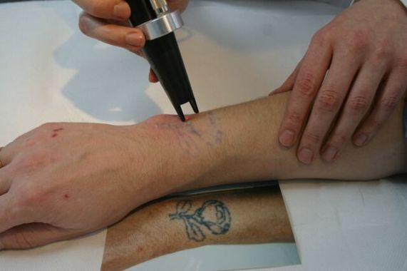 Remove your Tattoo