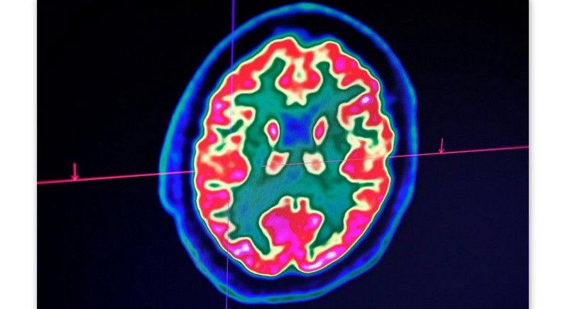 Confusion, seizure, strokes: How COVID-19 may affect the brain